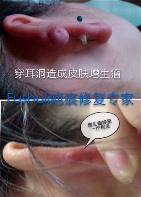 穿耳洞增生疤治疗